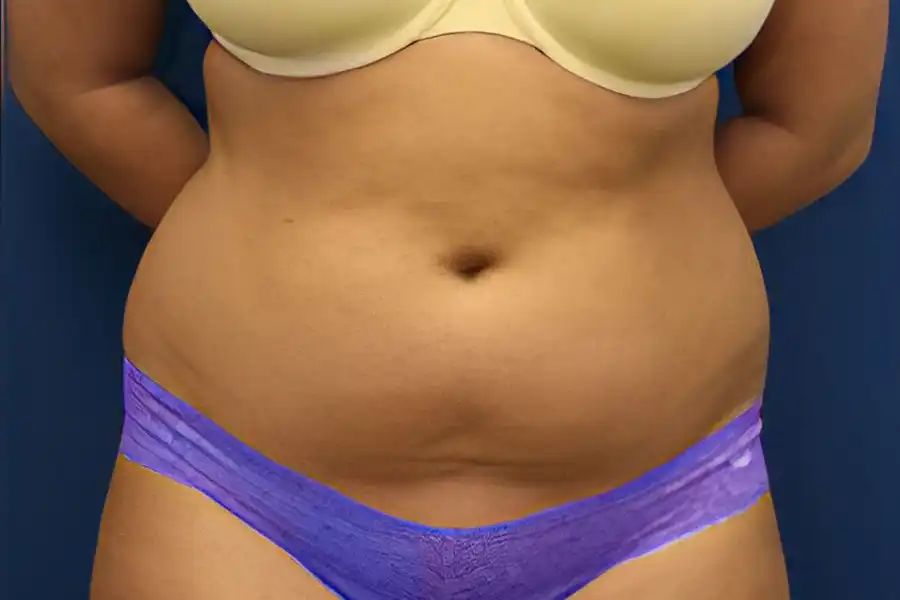 before weight loss photo of a woman's midriff with a yellow bra and purple underwear