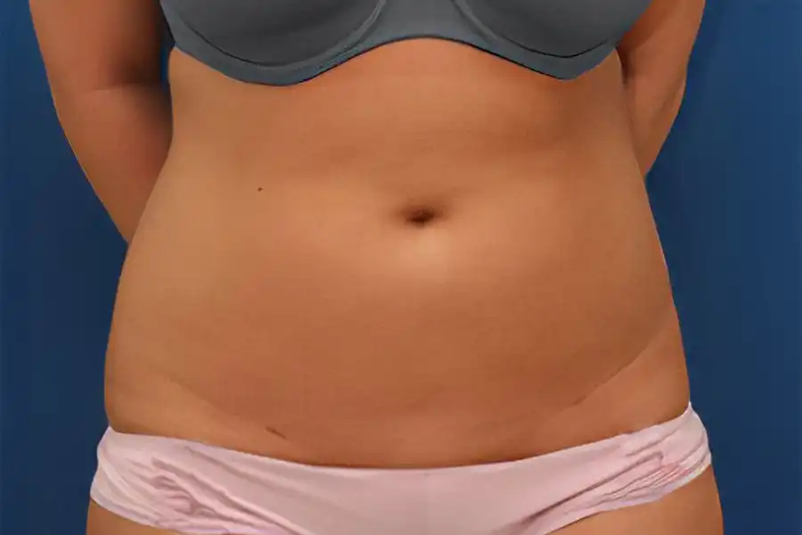 after weight loss photo of a woman's midriff with a black bra and pink underwear