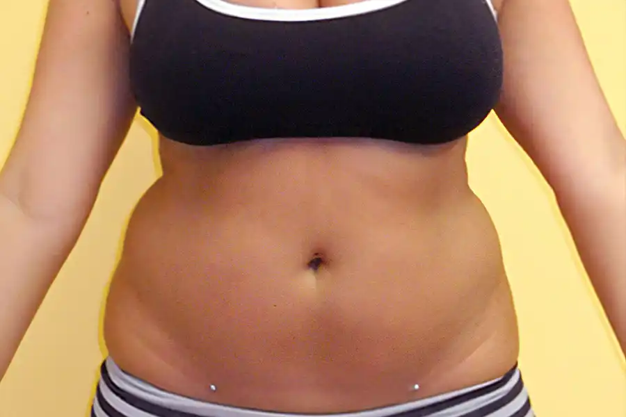 before weight loss photo of a woman's midriff wearing w black bra and striped underwear
