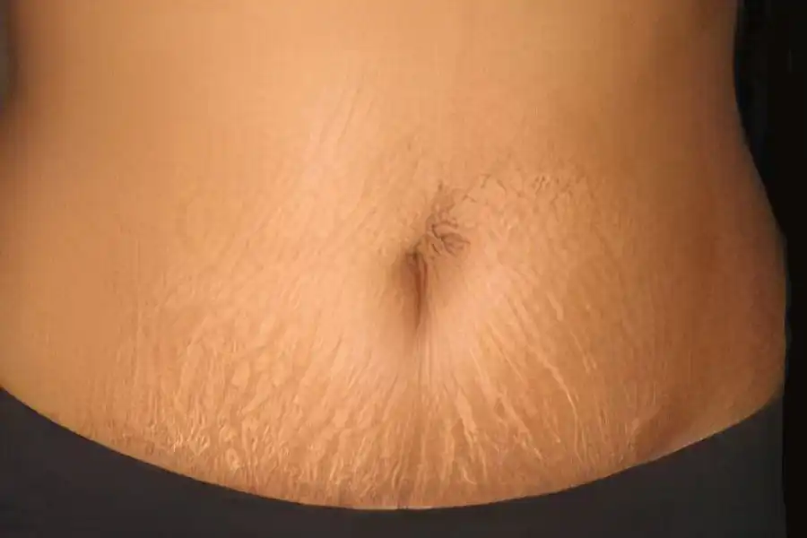stomach with stretchmarks
